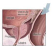 Examen de la prostata